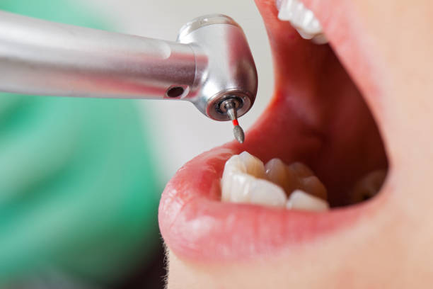 Best Emergency Treatment for Dental Infections or Abscesses in Easton, MD